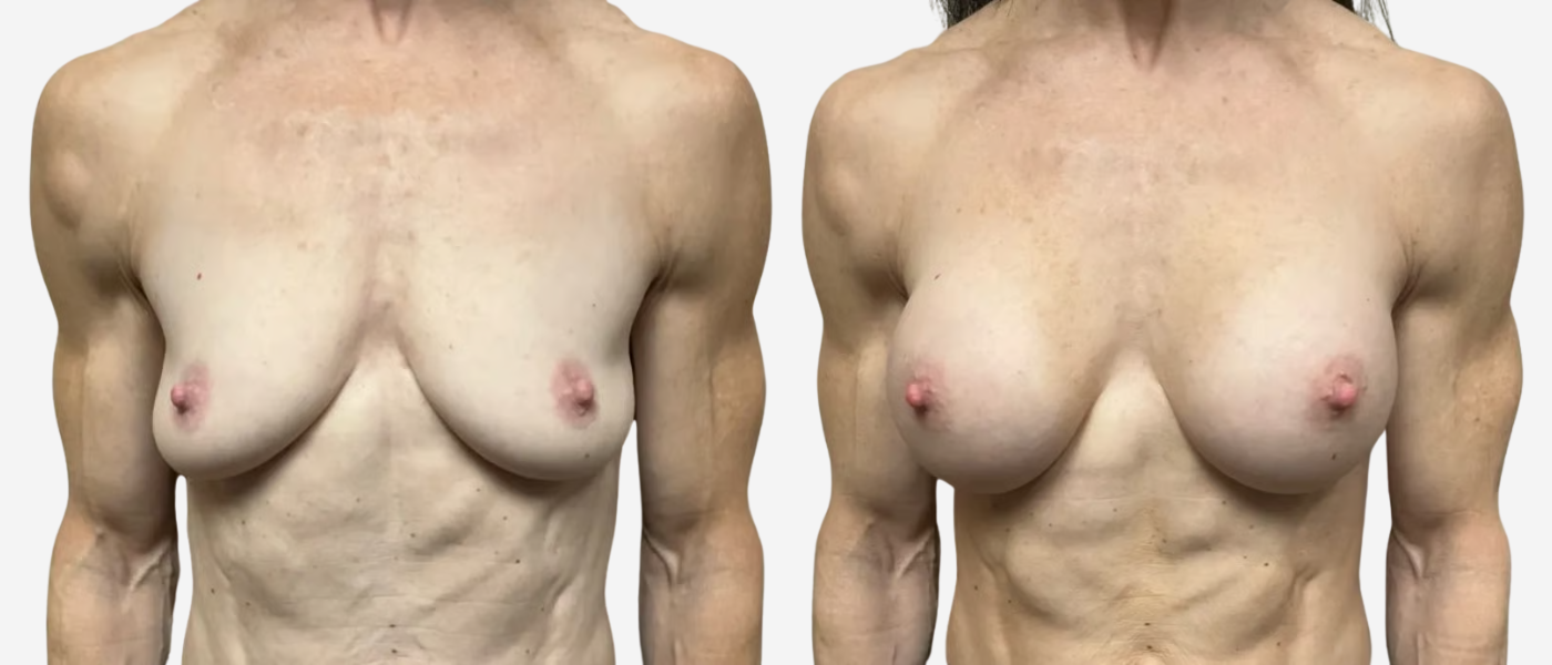 remington plastic surgery breast augmentation before and after results remington plastic surgery breast augmentation before and after results