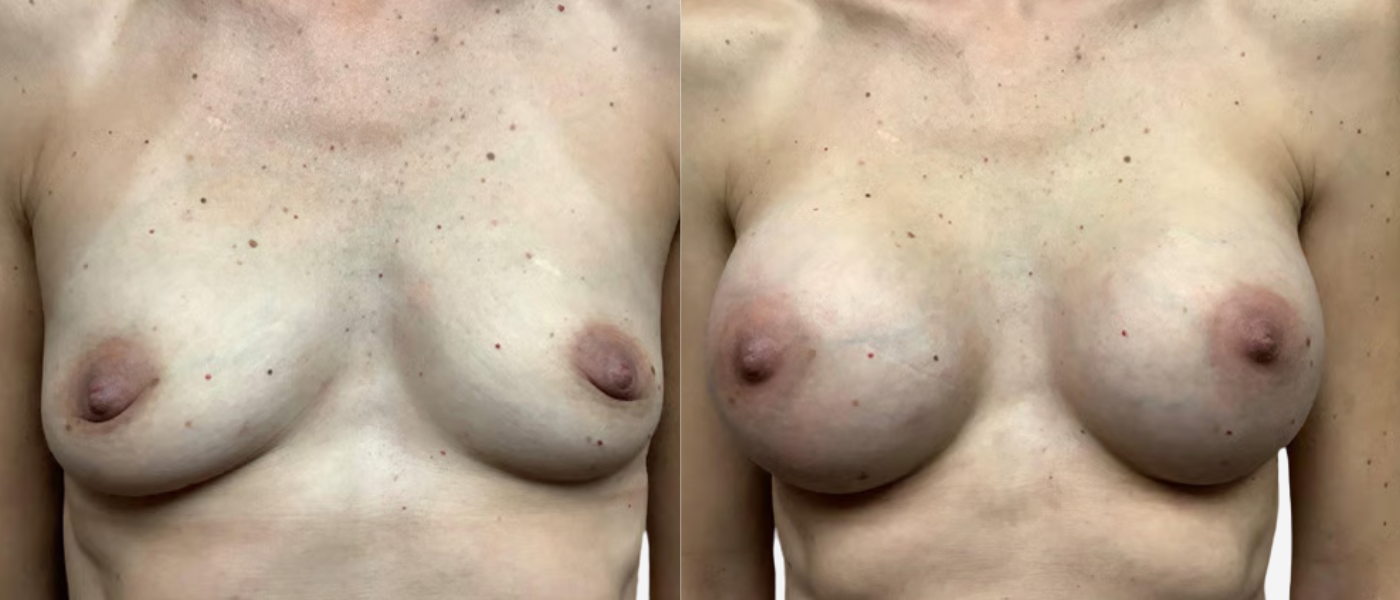 remington plastic surgery breast augmentation before and after results remington plastic surgery breast augmentation before and after results