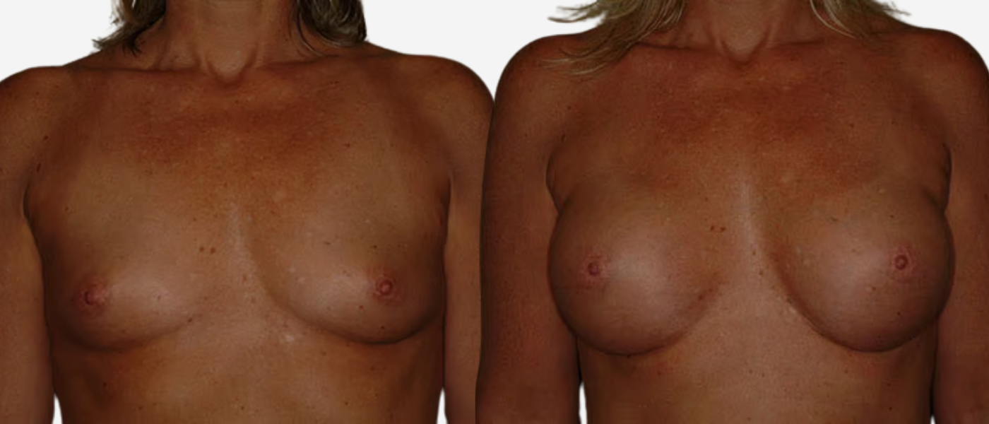 remington plastic surgery breast augmentation before and after results remington plastic surgery breast augmentation before and after results